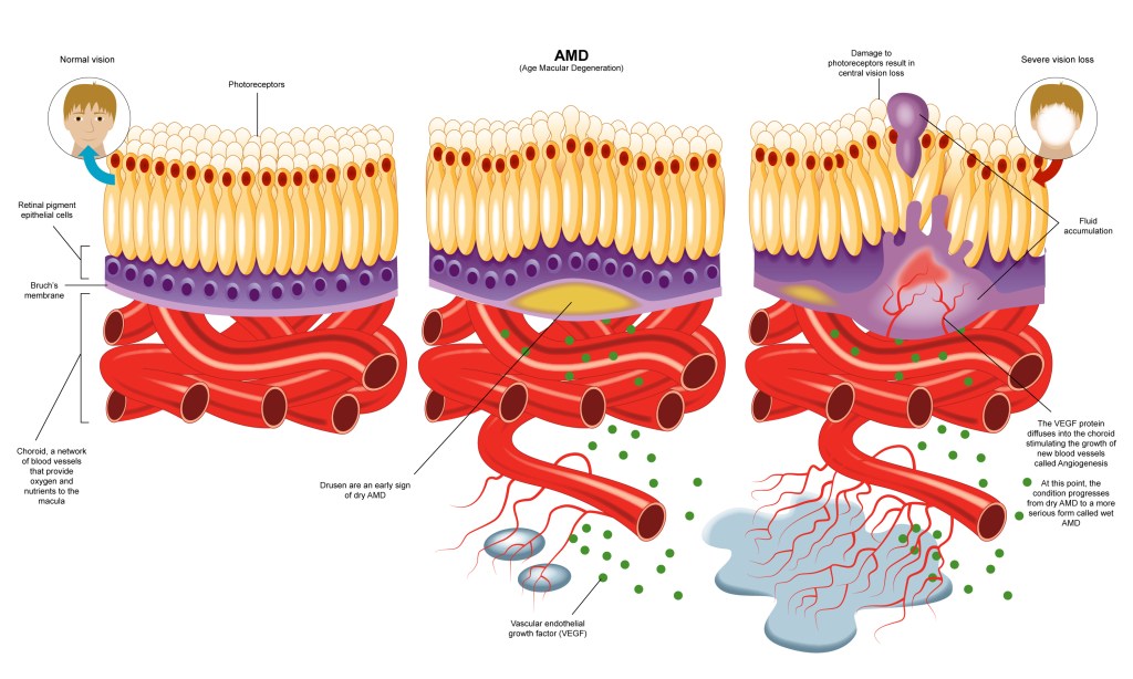 Illustration of the progression of AMD. New blood vessels grow into the retina disrupting vision